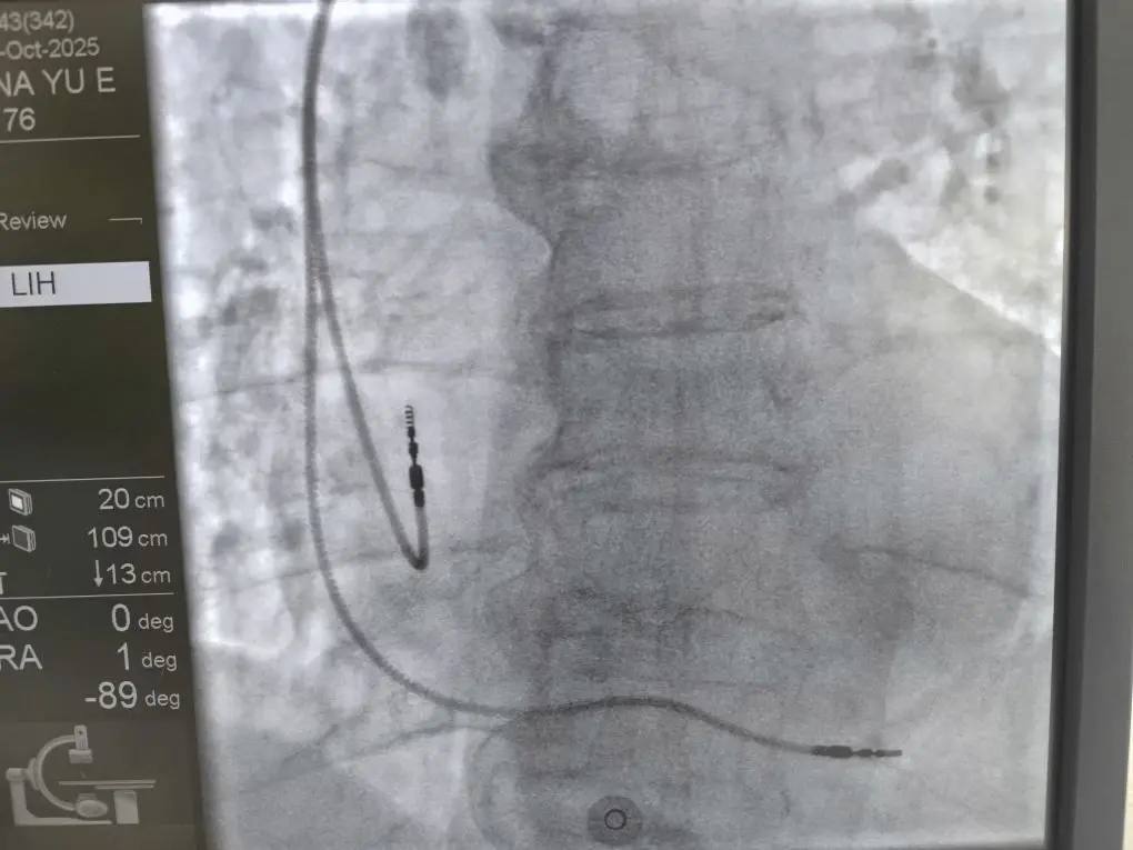 В Республиканской больнице впервые начали проводить операции по установке кардиостимуляторов В Республиканской больнице впервые начали проводить операции по установке кардиостимуляторов