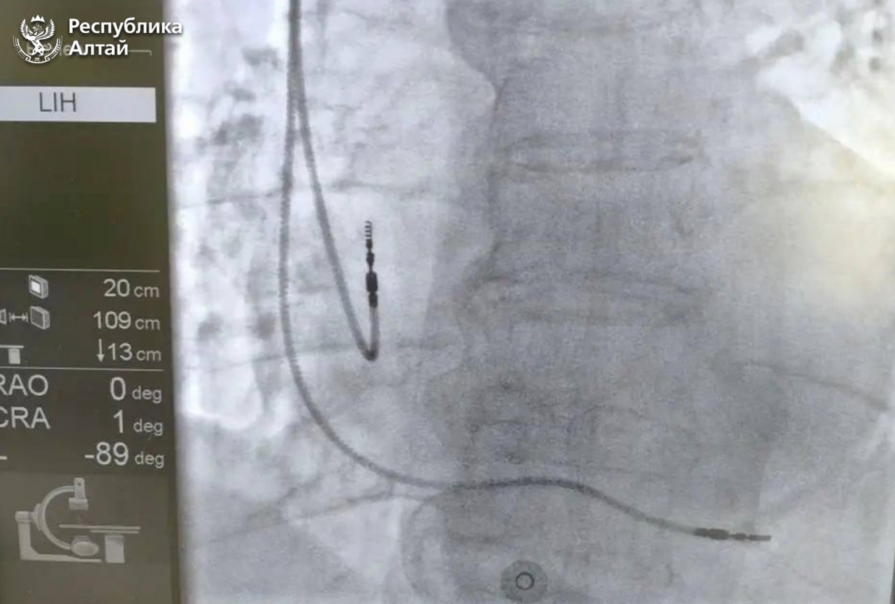 В Республиканской больнице впервые начали проводить операции по установке кардиостимуляторов В Республиканской больнице впервые начали проводить операции по установке кардиостимуляторов