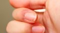 Как быстро избавиться от заусенцев: простые методы и народные рекомендации