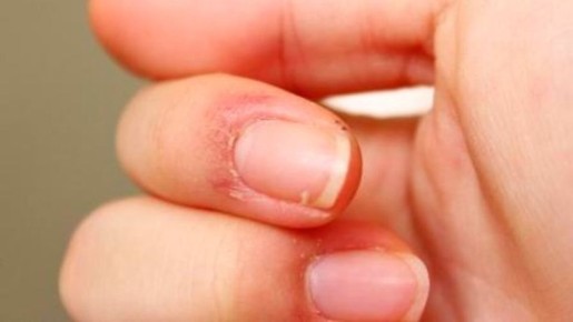 Как быстро избавиться от заусенцев: простые методы и народные рекомендации