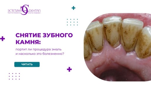Снятие зубного камня: что стоит знать о чувствительности и безопасности процедуры