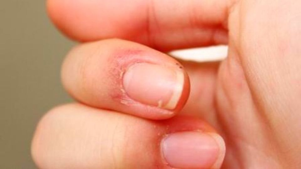 Как быстро избавиться от заусенцев: простые методы и народные рекомендации